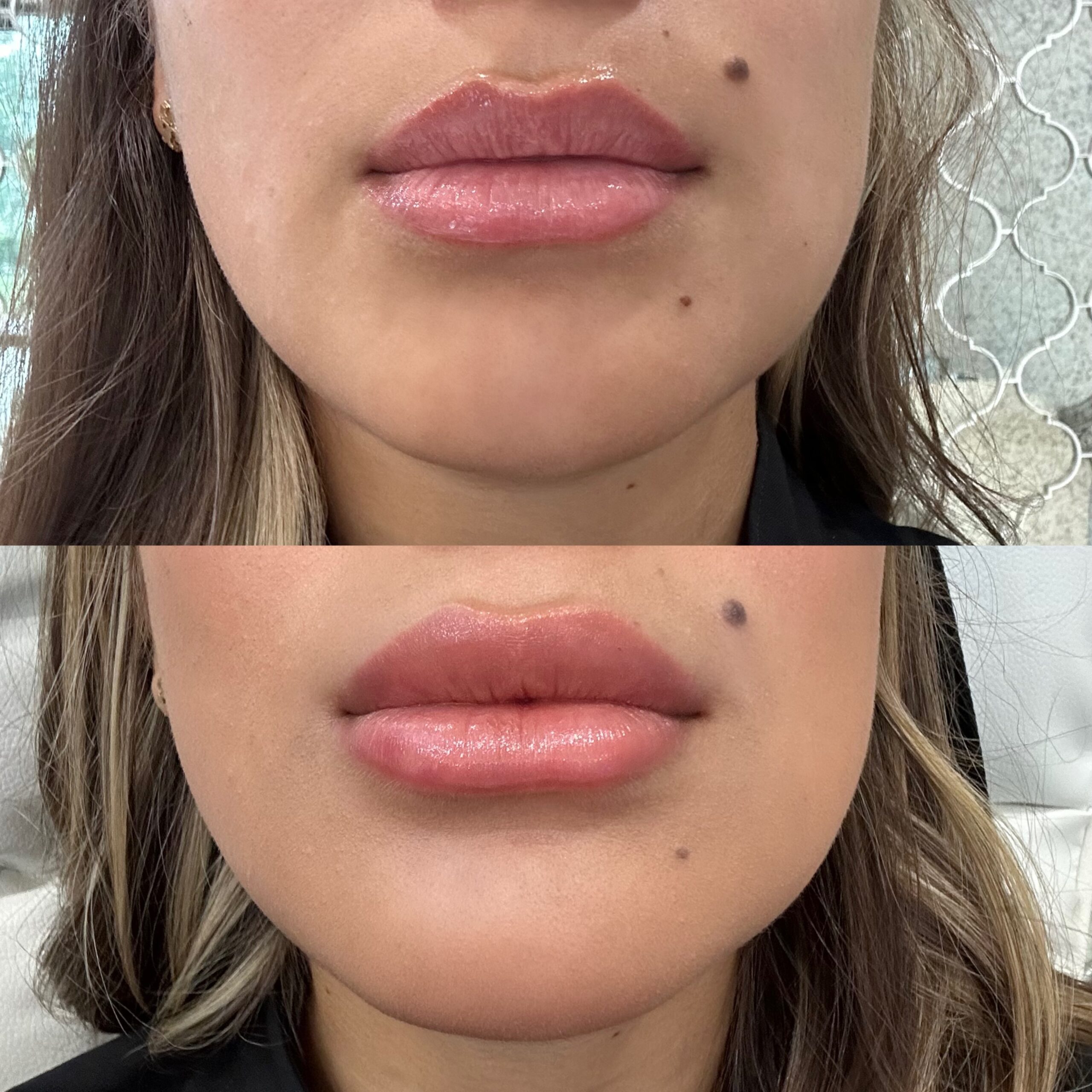 lip filler galiderm aesthetics