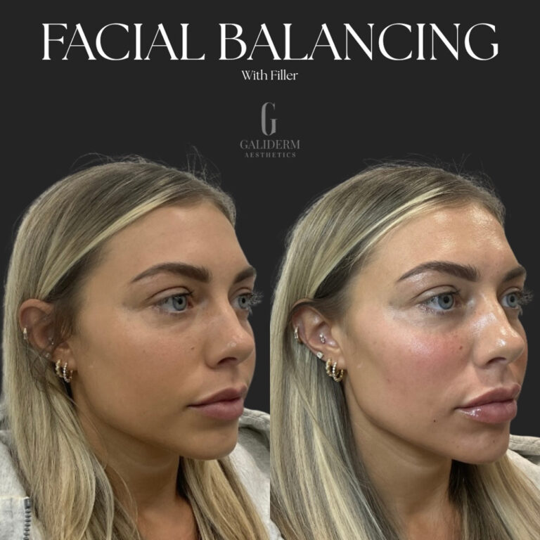 Facial balancing before and after at GaliDerm Aesthetics in West Palm Beach
