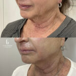 morpheus8 before and after neck