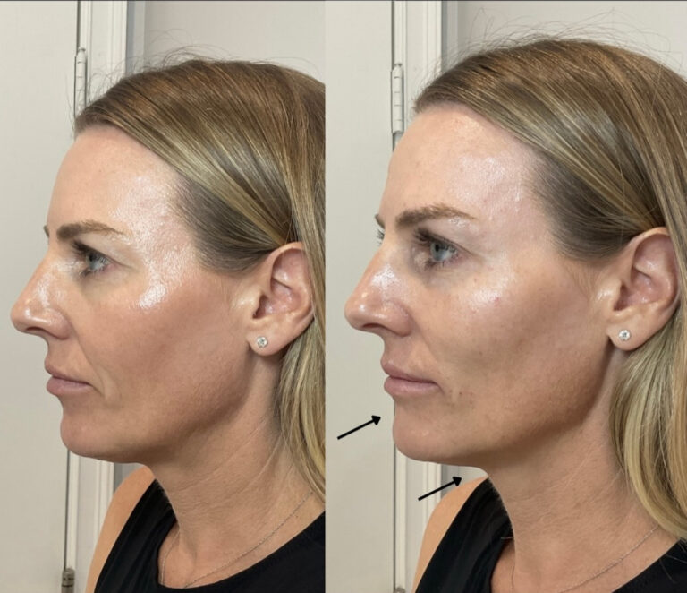 Facial balancing before and after, jawline and chin, at GaliDerm Aesthetics in West Palm Beach