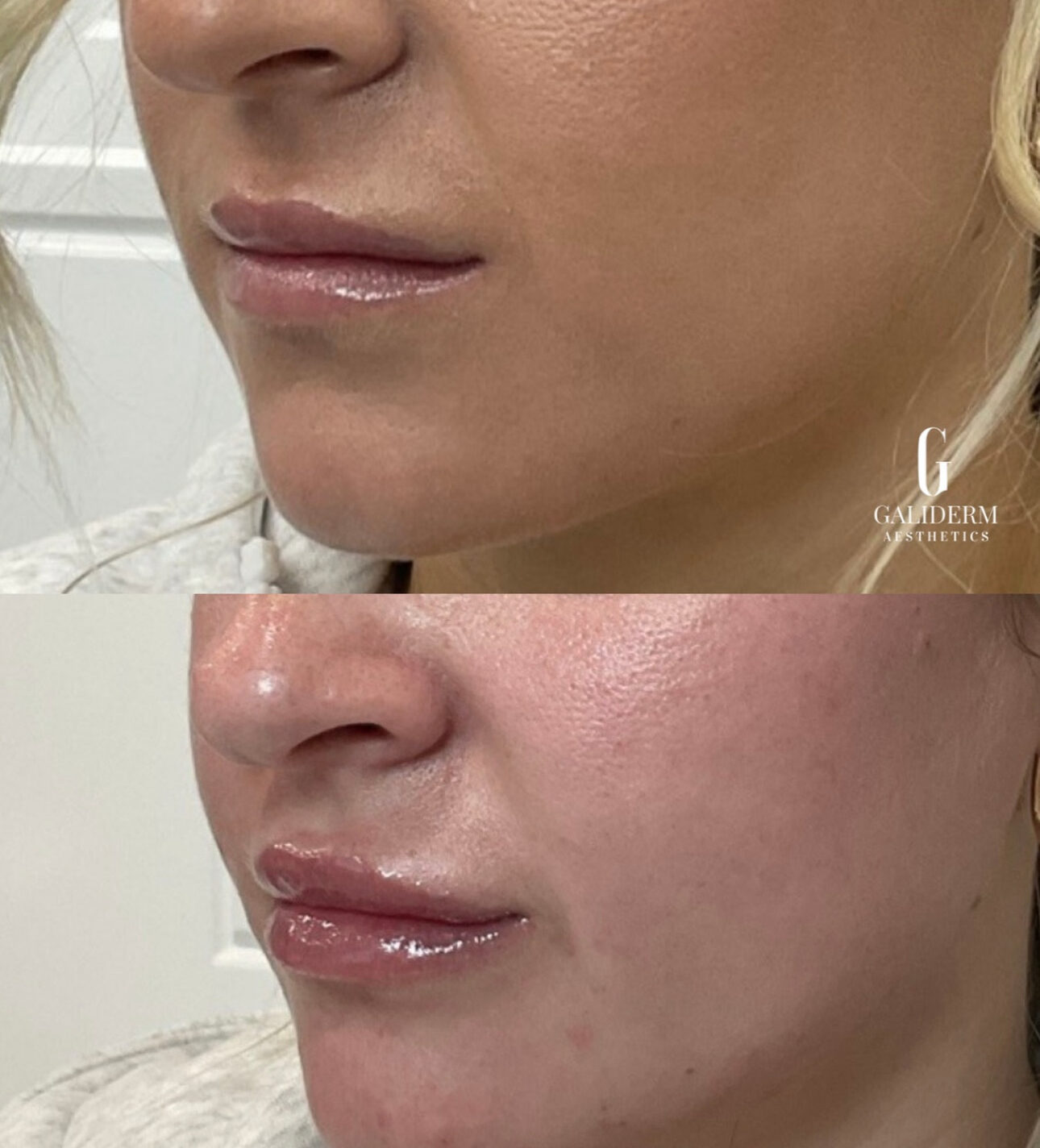 lip filler before and after