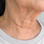 Understanding Neck Aging and How to Prevent It