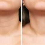 Understanding Neck Aging and How to Prevent It
