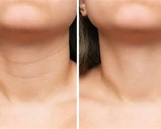 Understanding Neck Aging and How to Prevent It