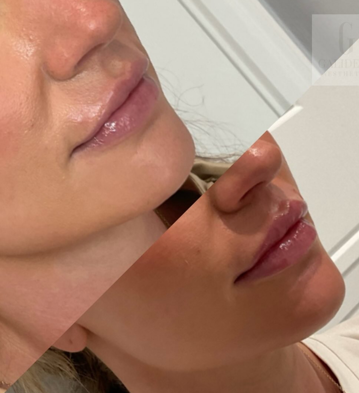 lip filler before & after 2