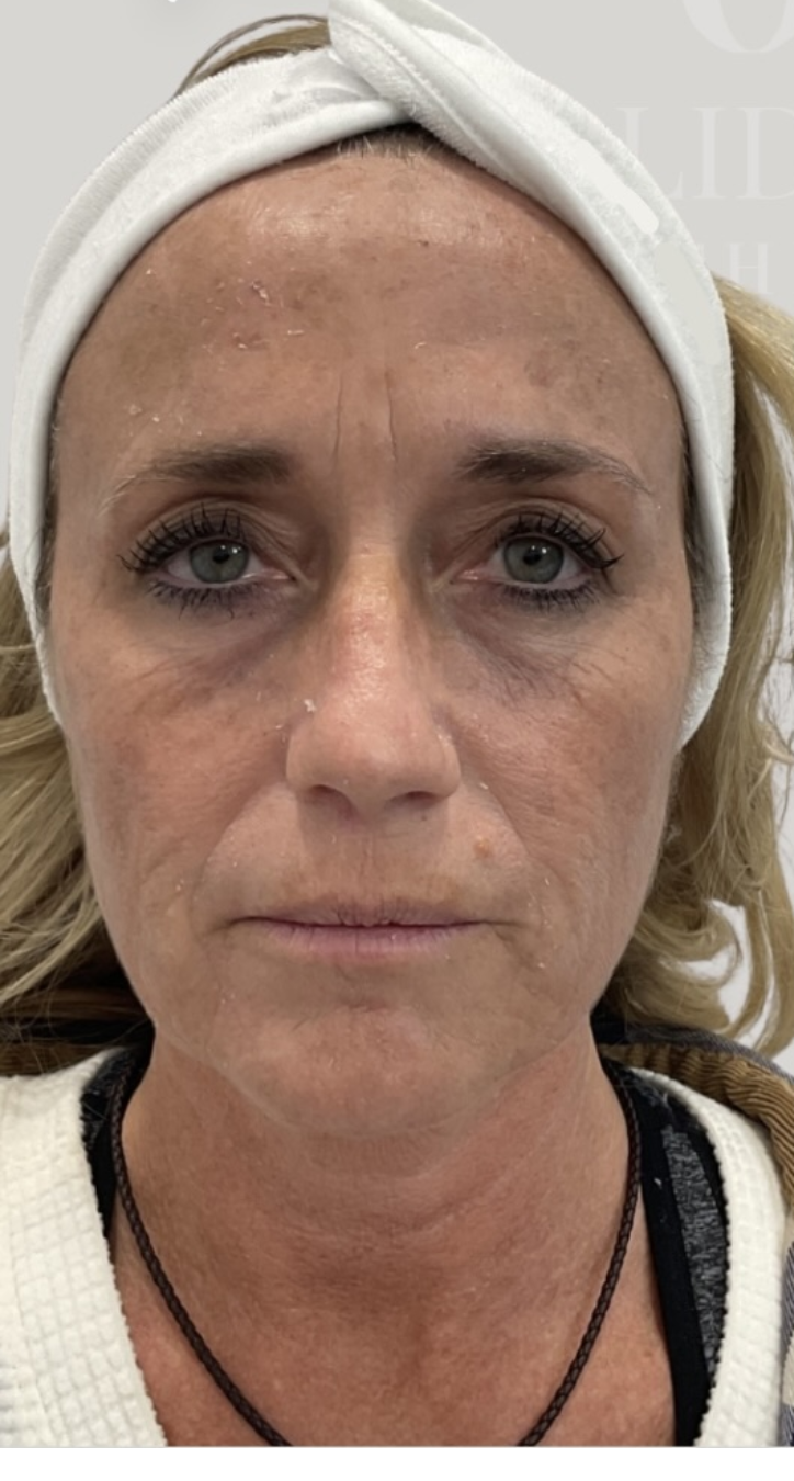 Before treatment