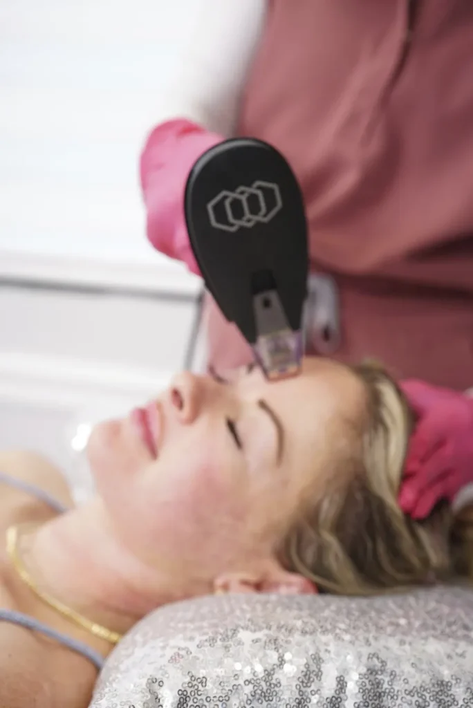 Morpheus8 RF microneedling facial treatment at GaliDerm Aesthetics in Royal Palm Beach, FL